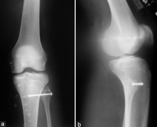 X-ray of the knee joint anteroposterior (a) and lateral | Open-i