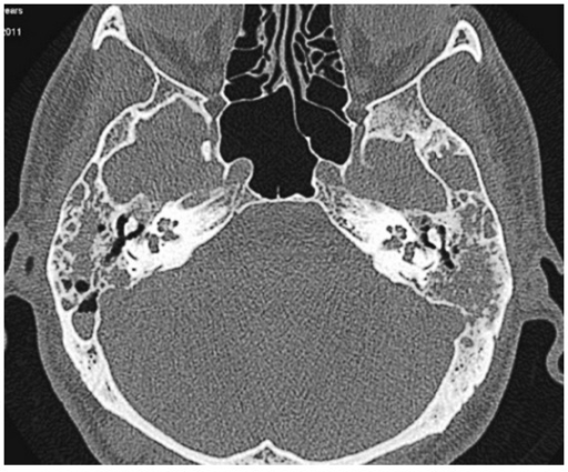 Preoperatively there is fluid intensity in the tympanic | Open-i