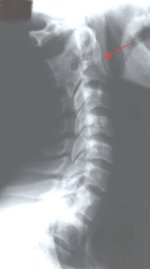 Congenital fusion of C2-3 | Open-i