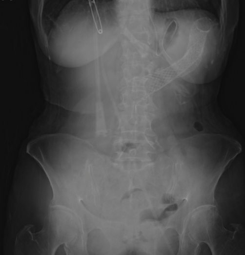 Abdominal X-ray after 3rd colonic stent. | Open-i