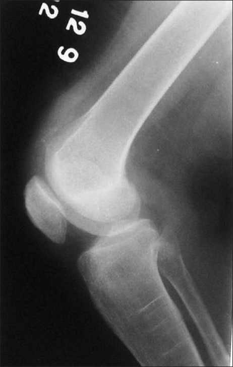 Quadriceps Tendon Calcification