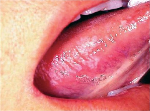 pseudomembranous candidiasis