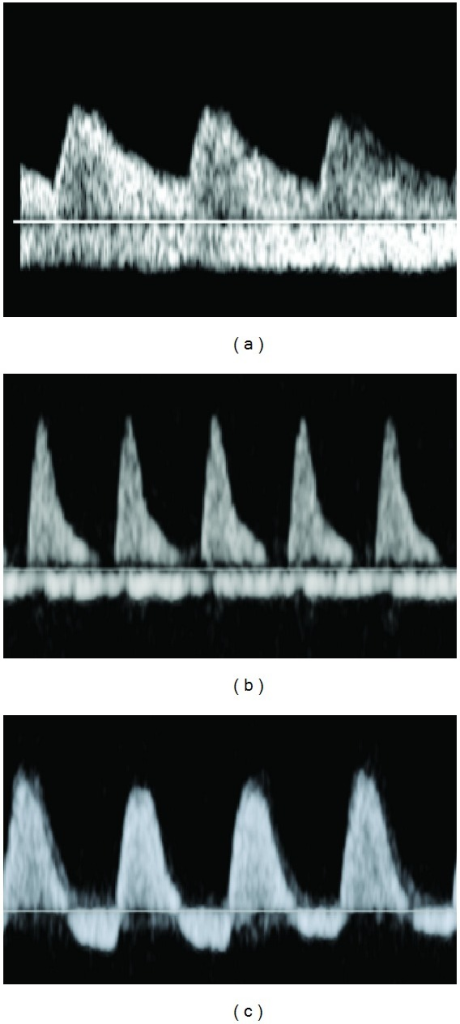 umbilical-artery-doppler-studies-examples-of-a-norma-open-i