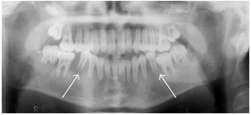 Panorex demonstrating resorption of alveolar bone of th | Open-i