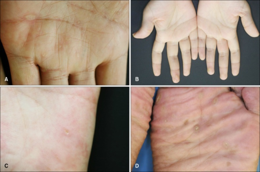 (A) Skin-colored, Flat-topped Papules Along The Palmar | Open-i