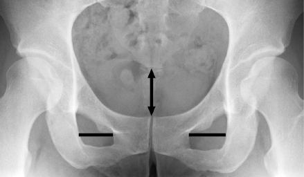 Hip X-ray in anteroposterior incidence showing measurement of the