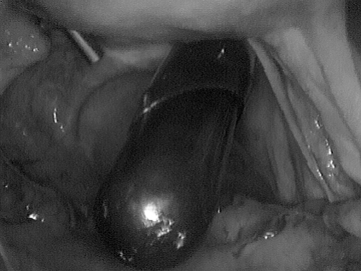Introduction Of The Vaginal Port A Plastic Rod Mounted