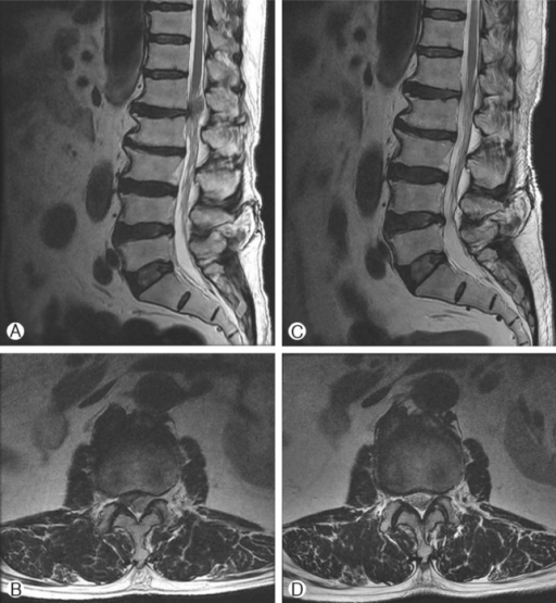 Lumbar MR Images show right disc extrusion at the L 1-2 | Open-i