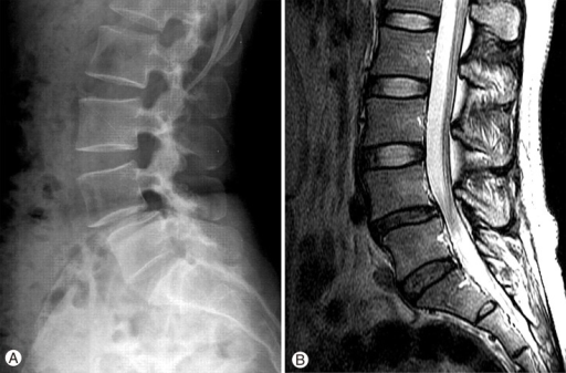 A 36-year-old woman with L4-5 degenerative spondylolist | Open-i