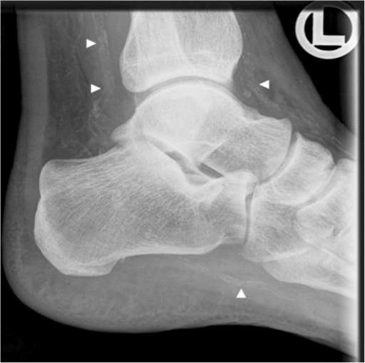 X-ray of right ankle. Severe calcification of the anter | Open-i