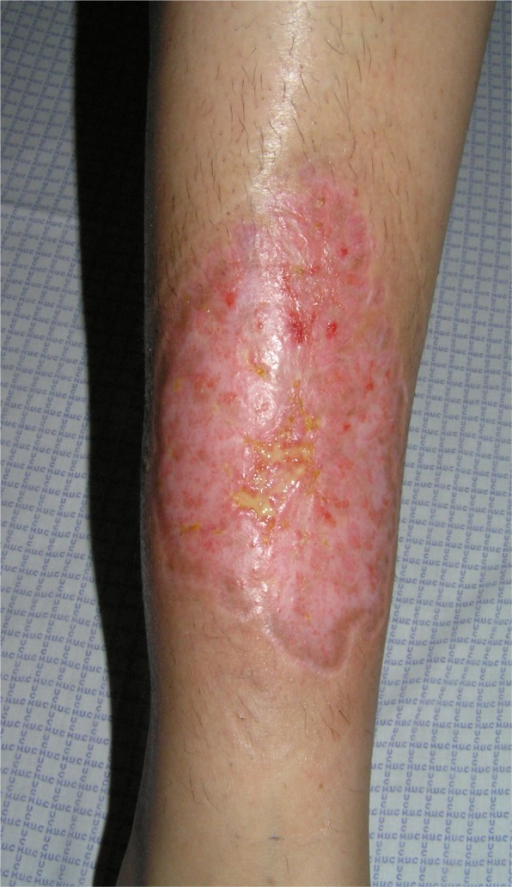 Characteristic cribriform scar after healing of pyoderm | Open-i