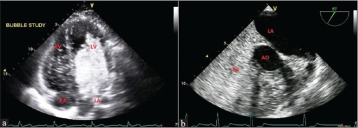 a-transthoracic-echocardiogram-bubble-study-with-agit-open-i