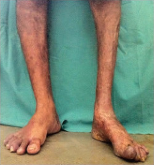 Leg Muscle Atrophy Icd 10