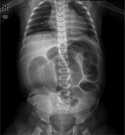 Intussusception in a 4-month-old girl. She had develope | Open-i