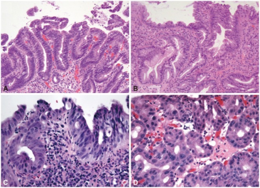 Barrett esophagusassociated dysplasia. (A) Lowgrade d