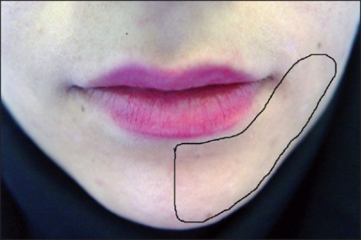 region-of-the-left-lower-lip-affected-by-paresthesia-open-i