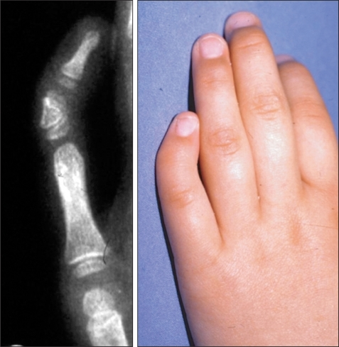 Case #7, left hand: clinodactyly of the little finger d | Open-i