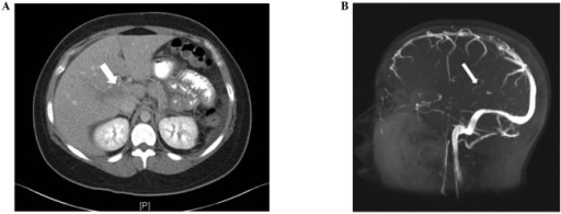 A Contrast abdominal CT scan showing a hypodensity an Open i