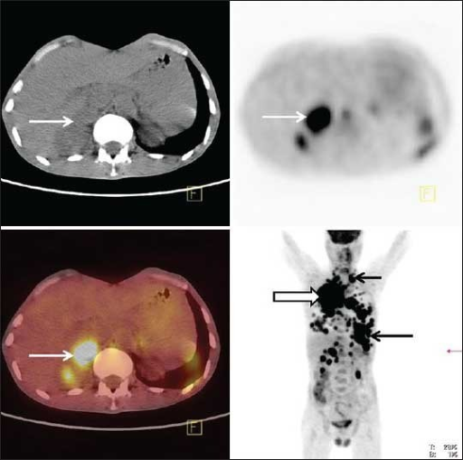 fdg-pet-ct-scan-for-detection-of-metastases-fdg-pet-ct-open-i