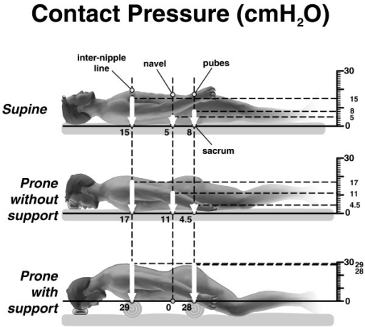 Patients' positions and contact pressures. Patients' po | Open-i