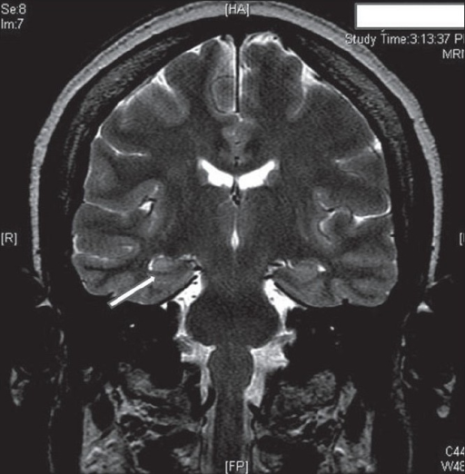 Hippo Campus Mri Sagittal