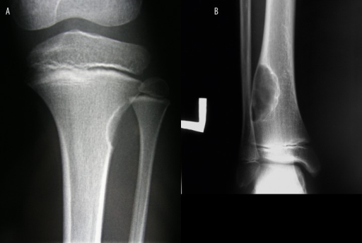 cortical-fibrous-defect-versus-non-ossifying-fibroma-open-i