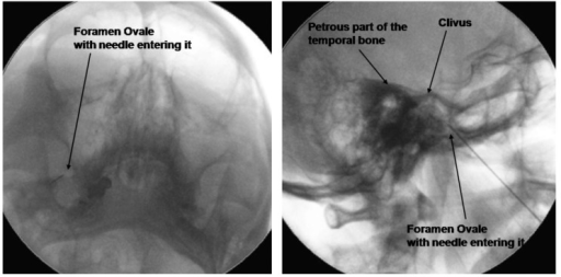 Submental View (With a 5 Â°Oblique Tilt) of the Foramen Ovale and Lateral View to Confirm the Depth of Needle Insertion