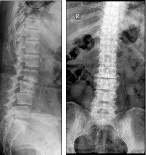 Plain radiographs of the lumbar vertebrae, anteroposter | Open-i