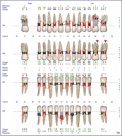 Florida Probe periodontal chart at the end of observati | Open-i