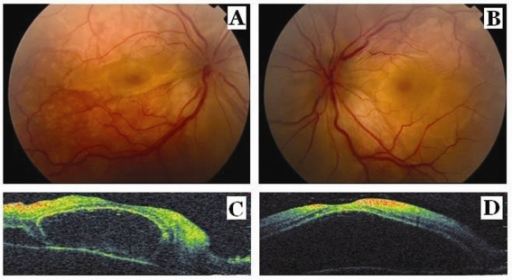Fundus Photographs Show Serous Macular Detachment And Retinal Folds Optic Disc Edema In The Right Fundus Photographs Show Serous Macular Detachment And Retinal Folds Optic Disc Edema In The Right