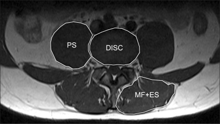 Cross Sectional Area Of Paraspinal Muscles. T1 Axial Im | Open-i