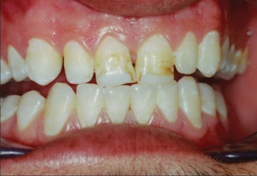 Photograph of a patient with moderate fluorosis before | Open-i