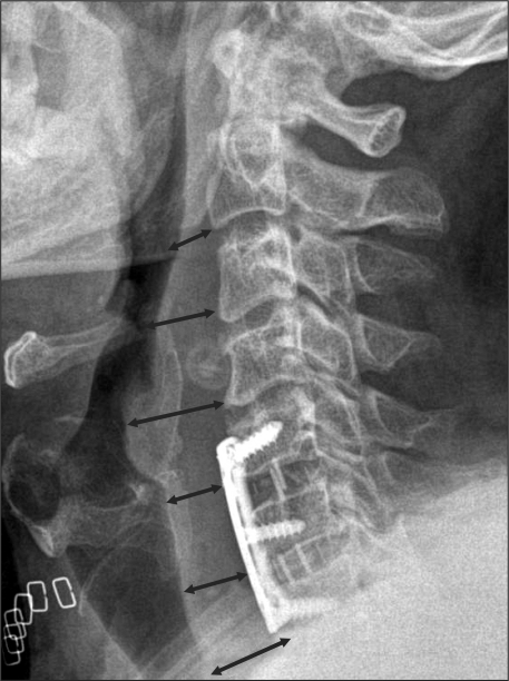 Measurement method of prevertebral soft tissue swelling | Open-i