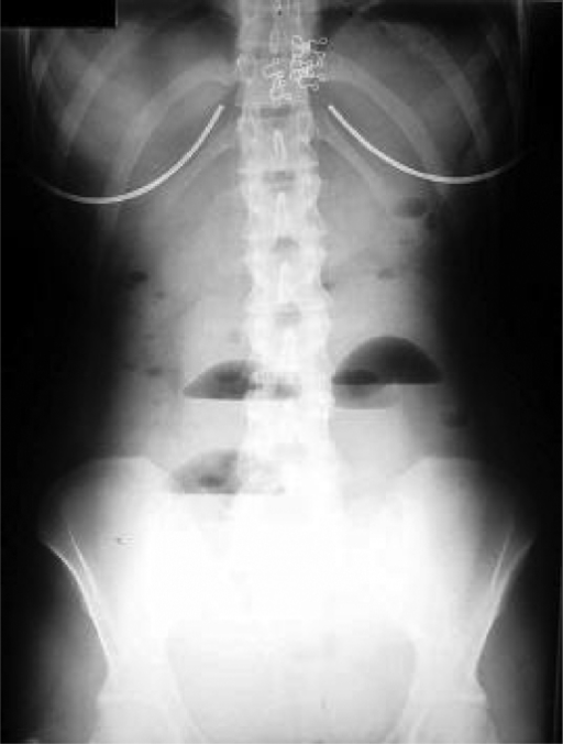 excess abdominal fluid