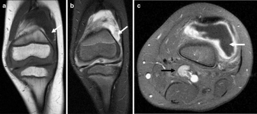 MRI of the knee of a 5-year-old boy with confirmed JIA. | Open-i