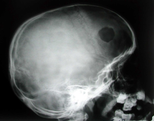 Lytic lesion in the skull | Open-i