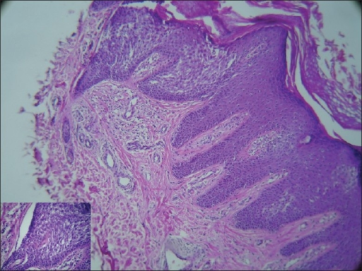 hyperkeratosis papillomatosis és acanthosis)