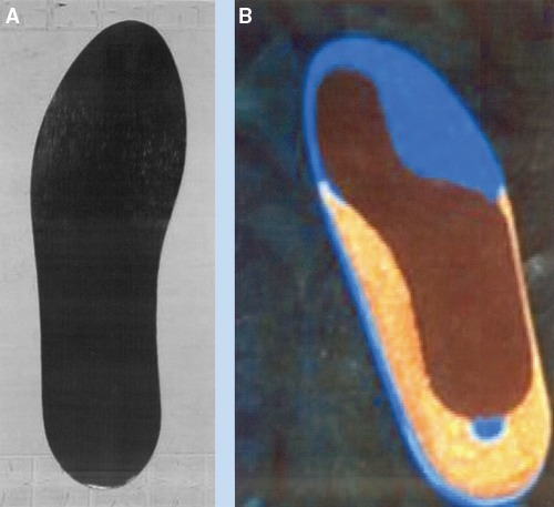 Orthotic options for turf toe injury: A, carbon-fiber t | Open-i