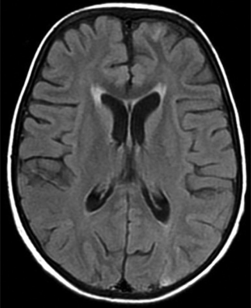 Normal Brain Mri Axial Flair