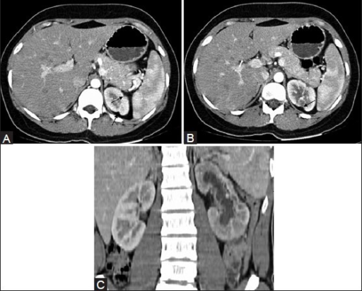 ct-revealing-a-focal-renal-cortical-scarring-arrows-open-i