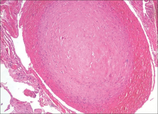 Photomicrograph Showing An Organizing Thrombus Within A Open I