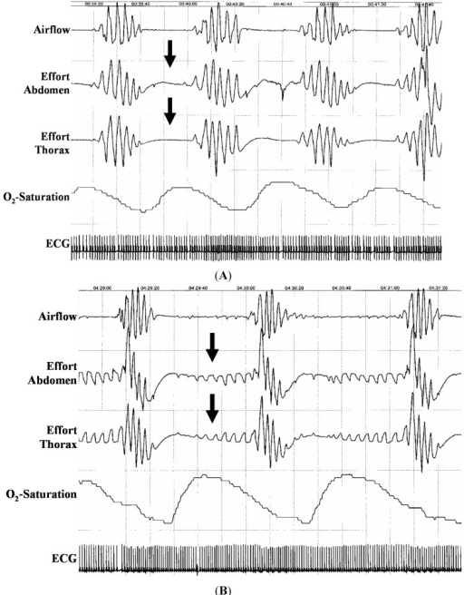 Polysomnography (3 min) with central sleep apnea (A) an | Open-i