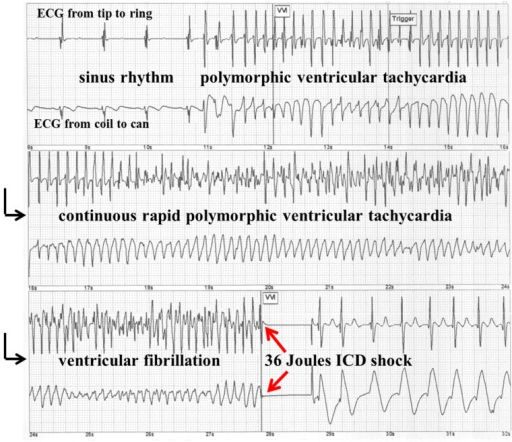 Stored implantable cardioverter defibrillator (ICD) ele | Open-i