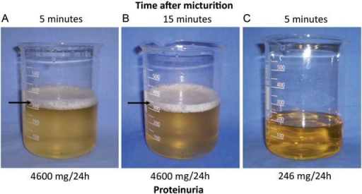 Prolonged Foamy Urine 5 Minutes A And 15 Minutes B After Urinating Directly Into A Beaker 3474
