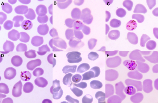 Light Microscopy Of P. Malariae Infection In Thin Perip | Open-i