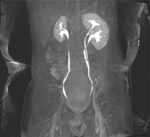 Duplication Of Pelvis And Ureter On The Left Side Hypo Open I