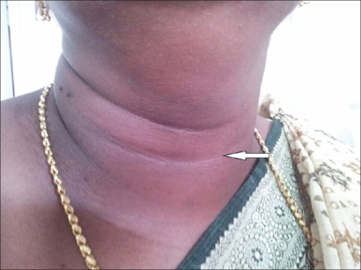 Unilateral thyroid swelling (left side) | Open-i