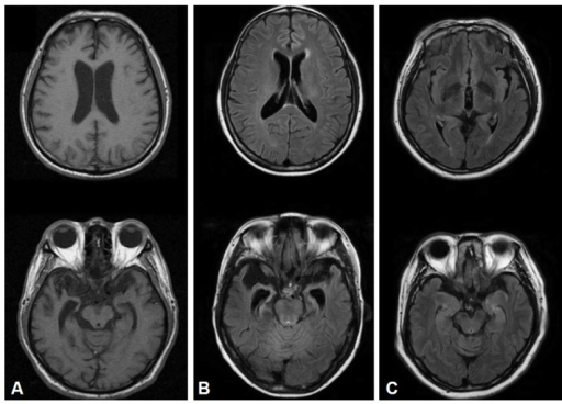 Frontal Lobe Dementia Stages