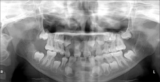 Panoramic radiograph showing missing teeth, delayed for | Open-i