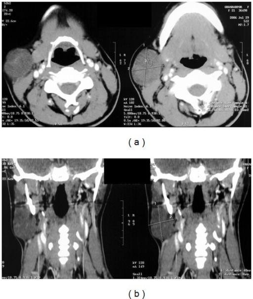 Contrast-enhanced CT scan in axial views of neck. A 36 | Open-i